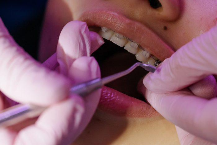 Zobu protēžu piegādēm ir, bet zobu brekešu piegādēm nav piemērojams atbrīvojums no PVN